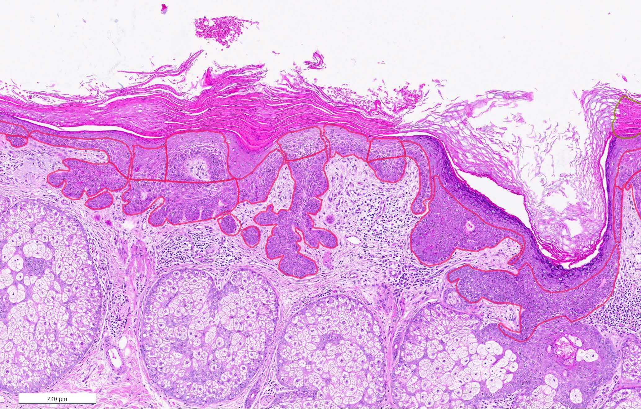 &lt;strong&gt;Figure 3.&lt;/strong&gt; Highly magnified view of one tissue slice from Figure 1. The epidermis (dark purple) shows clear signs of actinic keratosis (red annotations), with finger-like proliferation into the dermis. Figure courtesy of Centroderm and aisencia.