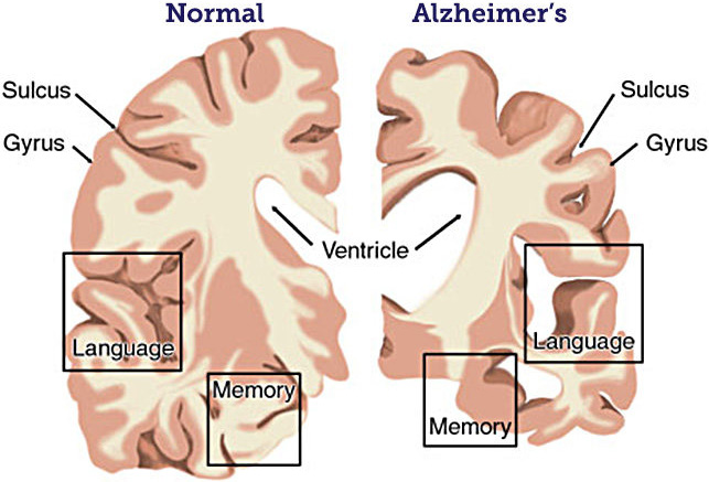 &lt;strong&gt;Figure 2.&lt;/strong&gt; Cross-section of a normal brain versus a brain with Alzheimer&#x27;s disease, as seen from the front. Photo courtesy of the BrightFocus Foundation.