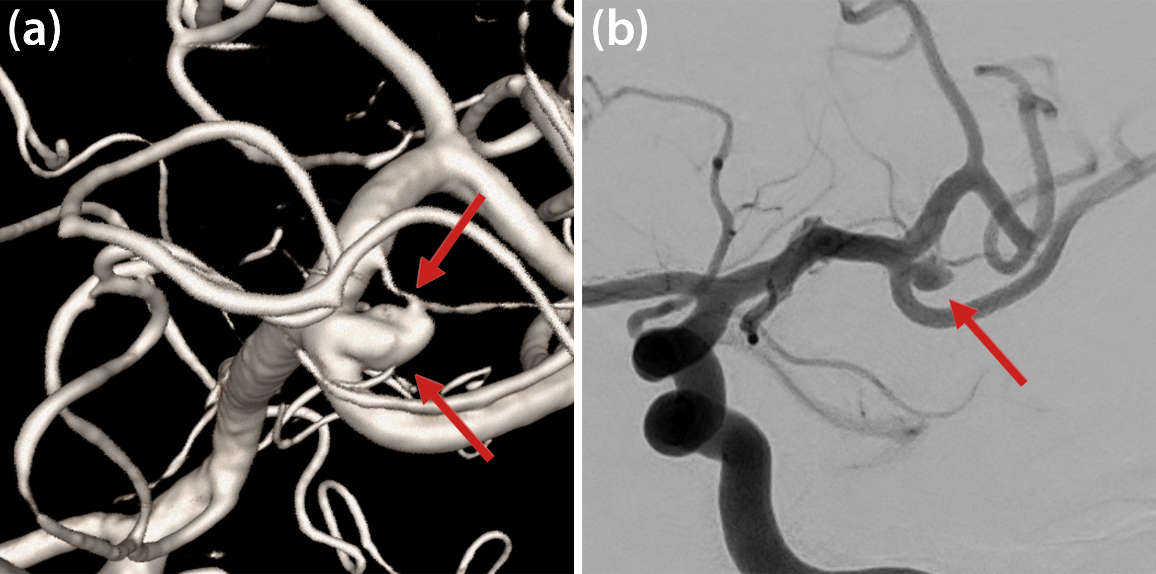 &lt;strong&gt;Figure 1.&lt;/strong&gt; A non-ruptured aneurysm (red arrow) at the left middle cerebral artery (MCA) bifurcation. &lt;strong&gt;1a.&lt;/strong&gt; Three-dimensional (3D) reconstruction of the vascular anatomy with 3D rotational angiography. &lt;strong&gt;1b.&lt;/strong&gt; Two-dimensional projection of the MCA aneurysm before coil implantation. Post-treatment images are evident in Figure 3. Figure courtesy of the authors.