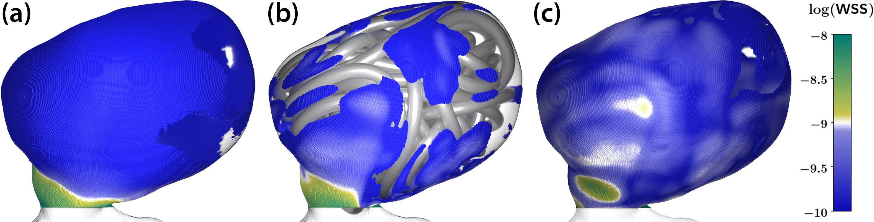 &lt;strong&gt;Figure 6.&lt;/strong&gt; Wall shear stress distribution over the aneurysm’s surface. &lt;strong&gt;6a.&lt;/strong&gt; The untreated case. &lt;strong&gt;6b.&lt;/strong&gt; The coiled (fully resolved) case. &lt;b&gt;6c.&lt;/b&gt; The porous medium surrogate model with the (comparably) coarse porosity field from Figure 5. Figure courtesy of the authors.