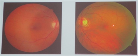 This fundus image depicts the presence of a microaneurysm in the early stages of diabetic retinopathy.