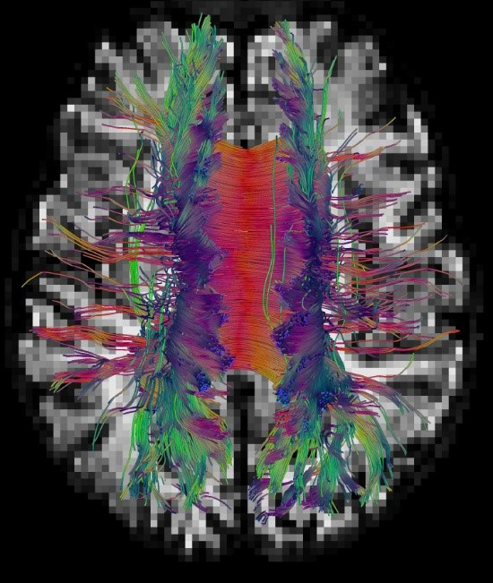 High-resolution 3D image of neural fibers in the human brain.