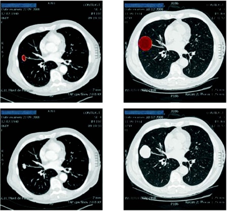 <strong>Figure 1.</strong> Computation of a metastasis to the lung. The images in the top row are from simulations, those at the bottom from CT scans.