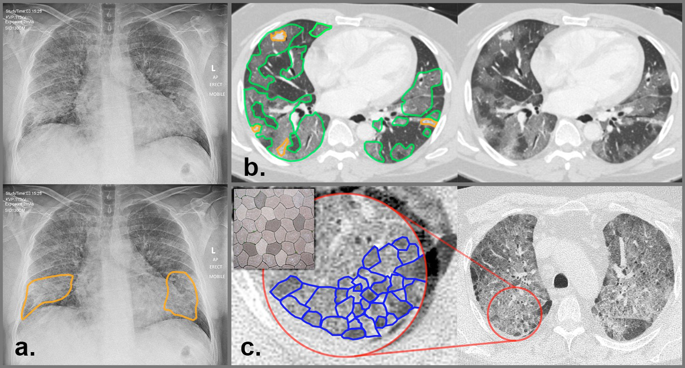 &lt;strong&gt;Figure 1.&lt;/strong&gt; Annotated examples of COVID-19 scans. &lt;strong&gt;1a.&lt;/strong&gt; Chest X-ray (CXR) with ground-glass opacification (GGO) in both lungs and consolidation (outlined in orange). &lt;strong&gt;1b.&lt;/strong&gt; A computed tomography (CT) scan that shows GGO (green) and consolidation (orange). &lt;strong&gt;1c.&lt;/strong&gt; A CT scan that indicates severe COVID-19 with a crazy-paving pattern. Images courtesy of [8] and inset courtesy of [5].