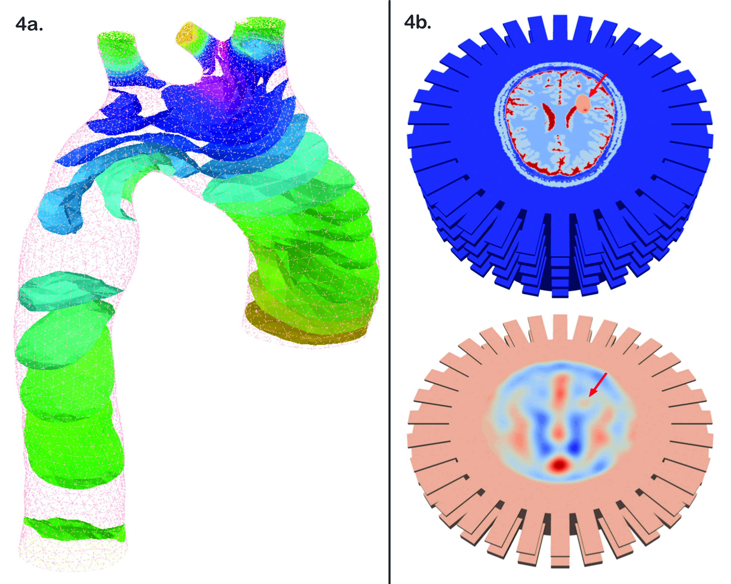 &lt;strong&gt;Figure 4.&lt;/strong&gt; Complex 3D examples. &lt;strong&gt;4a.&lt;/strong&gt; Iso surfaces of pressure in aortic blood flow. Image credit: Olivier Pironneau. More details in [1]. &lt;strong&gt;4b.&lt;/strong&gt; Navier-Stokes flow: iso-pressure surfaces. Blood flow reconstruction in the brain by simulation of Maxwell equations. Top: Target permitivity of the brain generated by high-precision imaging. Bottom: Computer-reconstructed image from noisy microwave measurements. The arrows indicate the region of stroke. Image credit: Frédéric Nataf.