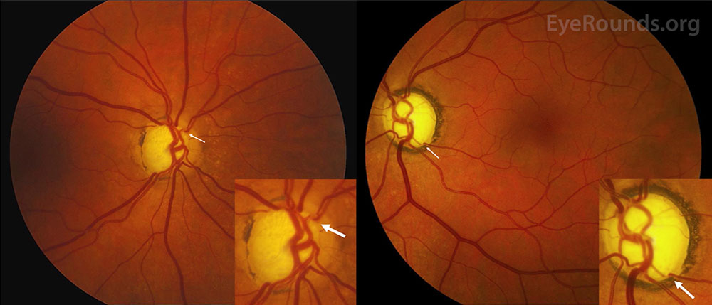 <strong>Figure 1.</strong> Fundus photograph that shows blood vessels in the eye of a patient with glaucoma. The arrows point to places where glaucoma has caused distortion in the vessels’ shape. Some researchers hope to use artificial intelligence to help identify medical conditions from fundus images. Figure courtesy of <a href="https://webeye.ophth.uiowa.edu/eyeforum/atlas/pages/bean-pot-cupping.htm#gsc.tab=0" target="_blank">EyeRounds.org/the University of Iowa</a> under the <a href="https://creativecommons.org/licenses/by-nc-nd/3.0/deed.en" target="_blank">Creative Commons Attribution-NonCommercial-NoDerivs 3.0 Unported</a> license.