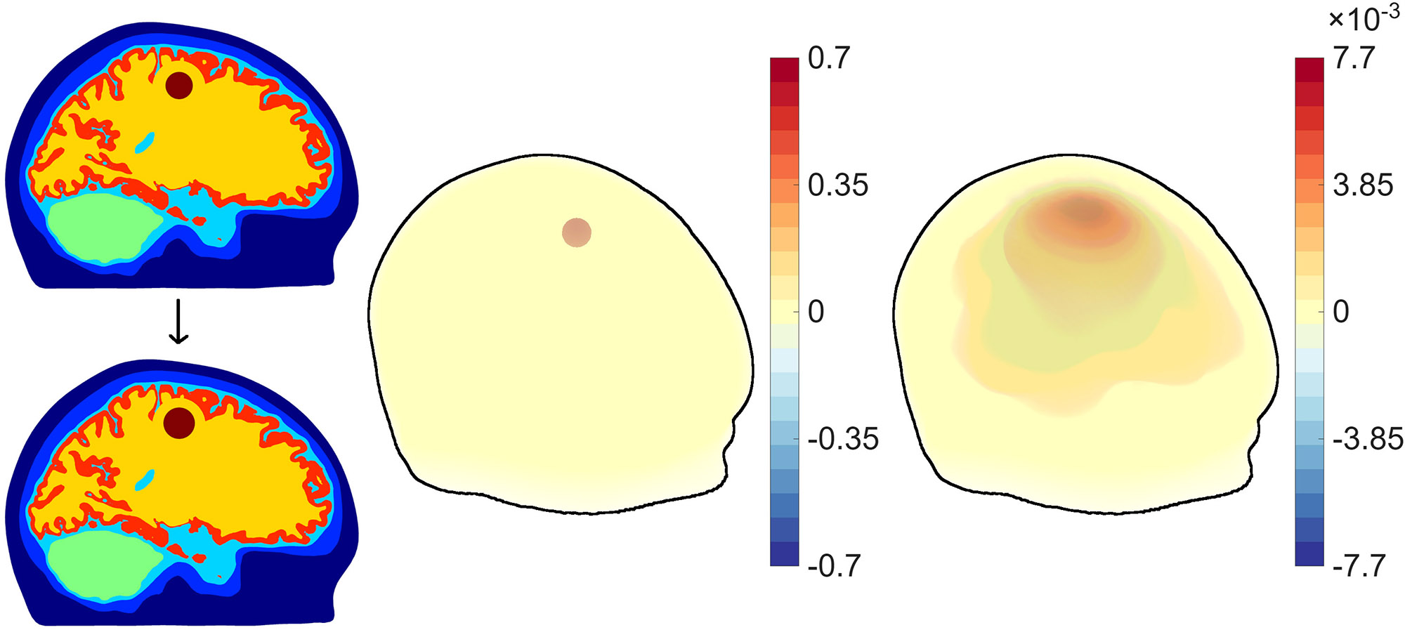 &lt;strong&gt;Figure 2.&lt;/strong&gt; Electrical impedance tomography can track the evolution of simulated hemorrhage in the brain, which supports the clinical application of continuous monitoring techniques for intensive care patients. Figure courtesy of Jussi Toivanen.