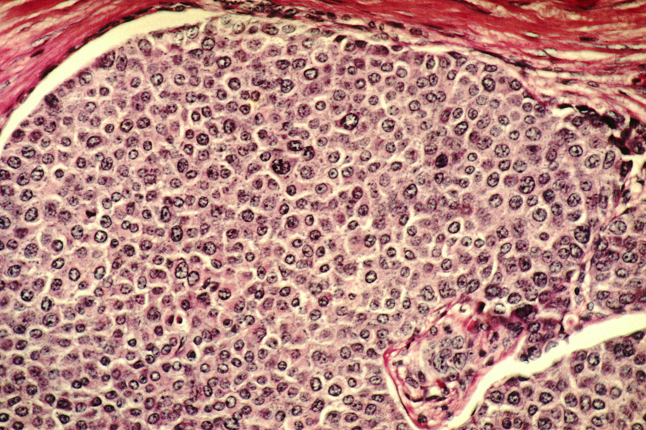 &lt;strong&gt;Figure 1.&lt;/strong&gt; Cells that display abnormal heterogeneous behavior—such as these breast cancer cells—are often indicative of cancer. Public domain image courtesy of &lt;a href=&quot;https://commons.wikimedia.org/wiki/File:Breast_cancer_cells.jpg&quot; target=&quot;_blank&quot;&gt;Cecil Fox&lt;/a&gt; and the &lt;a href=&quot;https://www.cancer.gov/&quot; target=&quot;_blank&quot;&gt;National Cancer Institute&lt;/a&gt;.