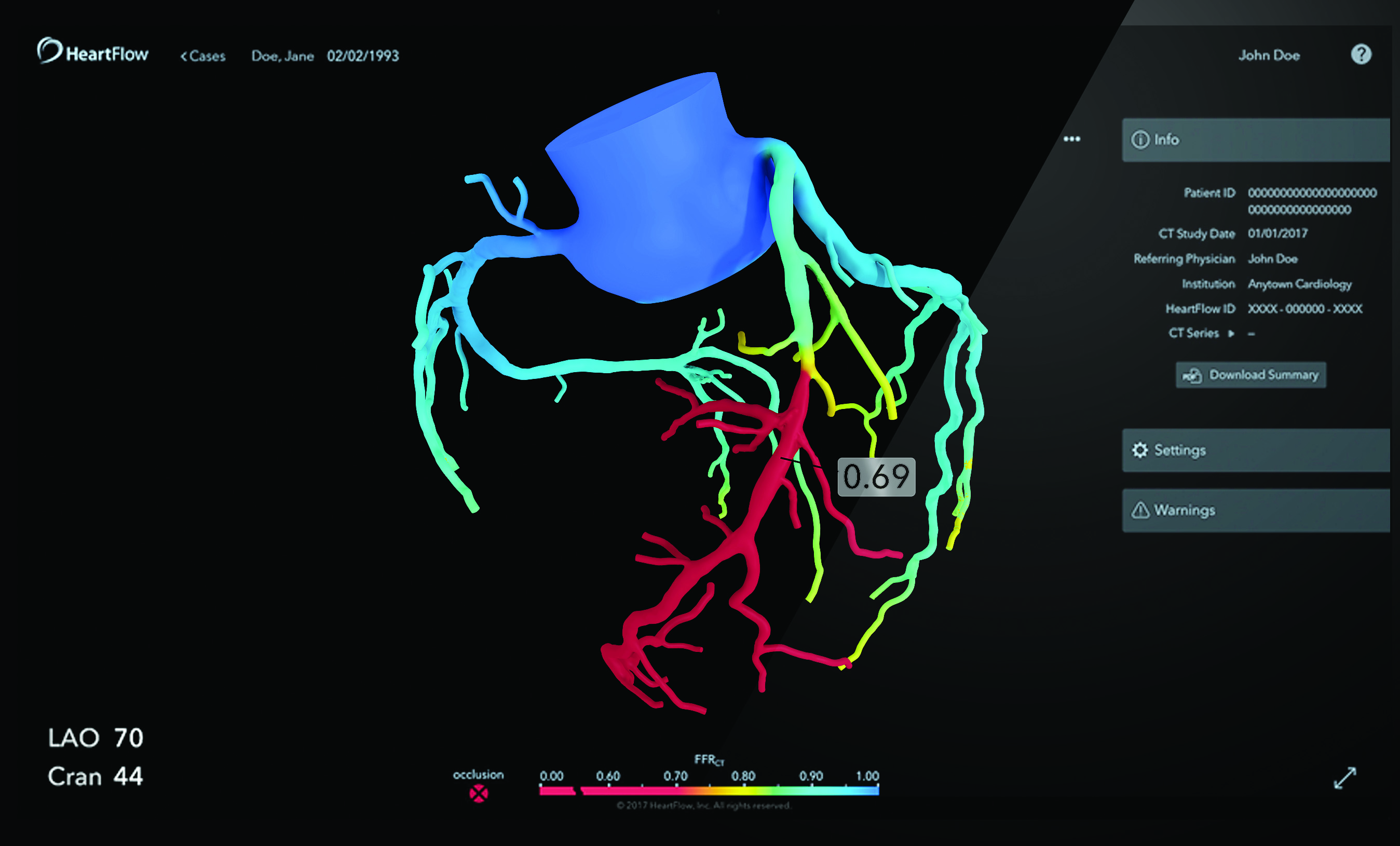 &lt;strong&gt;Figure 2.&lt;/strong&gt; The HeartFlow Analysis interactive three-dimensional model enables physicians to precisely diagnose and manage coronary artery disease. Figure courtesy of HeartFlow.