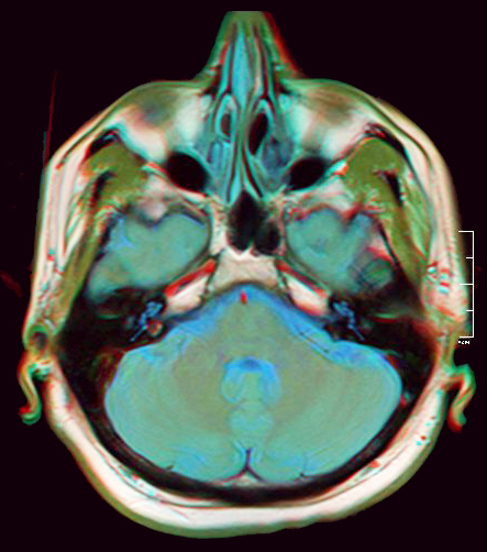 <strong>Figure 1.</strong> Magnetic resonance imaging scan of the brain. Public domain image.