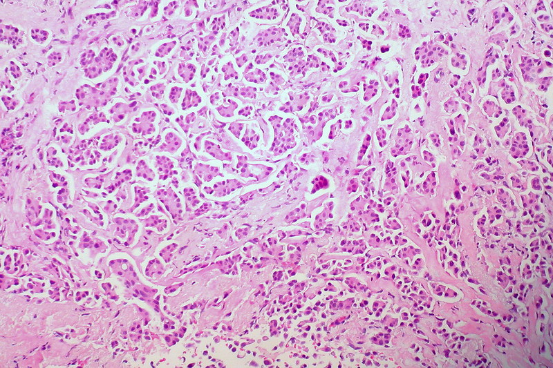 <strong>Figure 2.</strong> Cells that exhibit invasive micropapillary carcinoma, a rare form of breast cancer. Figure courtesy of <a href="https://www.flickr.com/photos/euthman/5300722946" target="_blank">Ed Uthman/Flickr</a> via the <a href="https://creativecommons.org/licenses/by/2.0" target="_blank">Creative Commons Attribution 2.0 Generic</a> license.