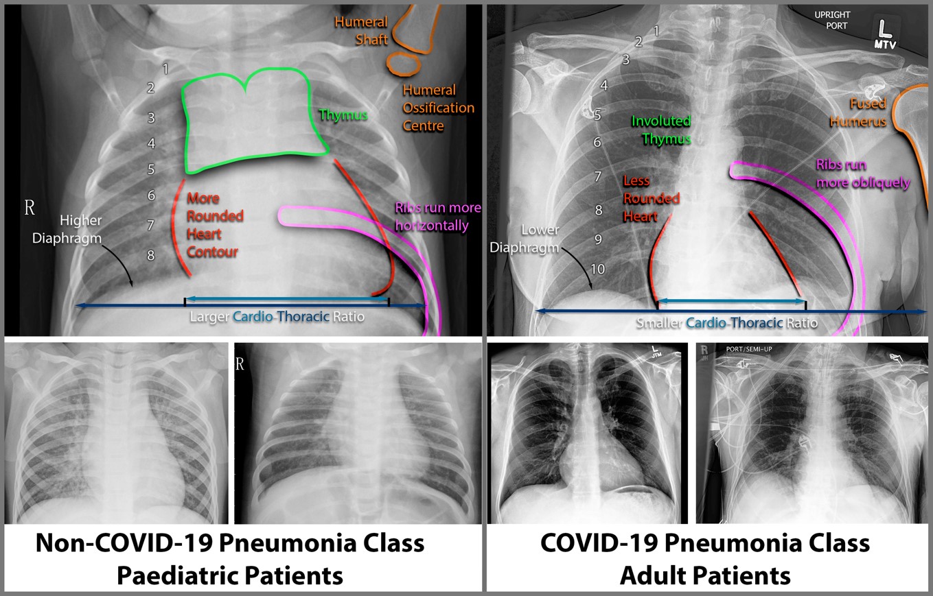 &lt;strong&gt;Figure 2.&lt;/strong&gt; Annotated chest radiograph indicating the differences between pediatric and adult patients. Pediatric scans courtesy of [9] and adult scans courtesy of [3].