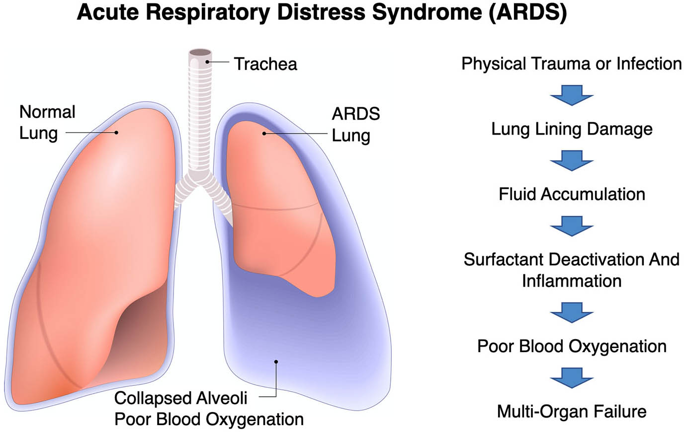 &lt;strong&gt;Figure 1.&lt;/strong&gt; Visual description of acute respiratory distress syndrome (ARDS) and its impact on the body. Public domain image.