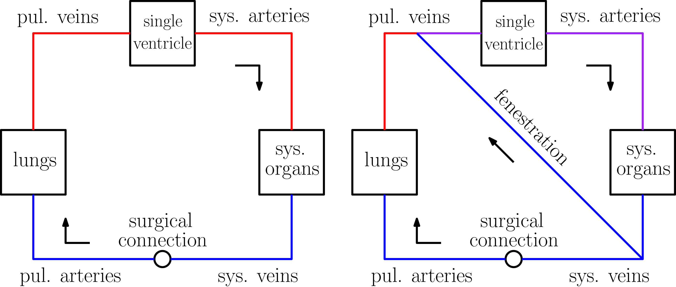 &lt;strong&gt;Figure 1.&lt;/strong&gt; The Fontan circulation without and with fenestration. Figure courtesy of Zan Ahmad.