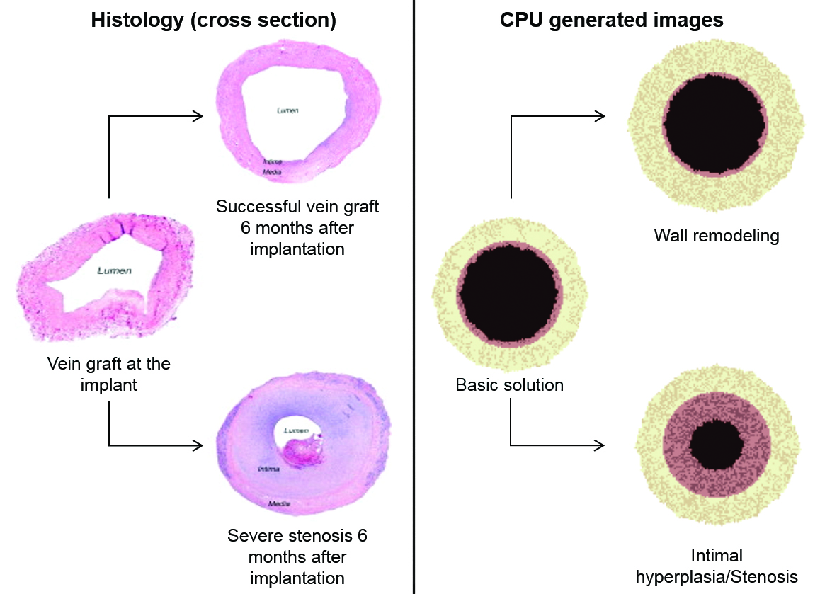 &lt;strong&gt;Figure 3.&lt;/strong&gt; Clinical observation of a vein graft success and failure six months after surgery (left), replicated with an agent-based model (right). The black portion represents the lumen, the pink portion represents the tunica intima, and the beige portion represents the tunica media. Image courtesy of [5].