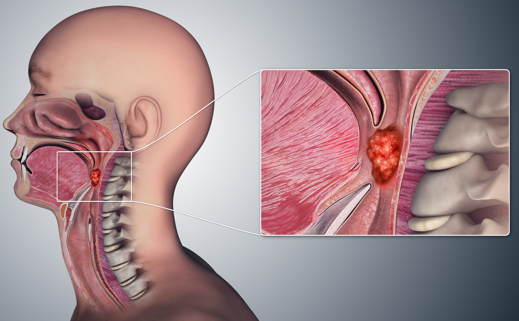 Development of oropharyngeal cancer.