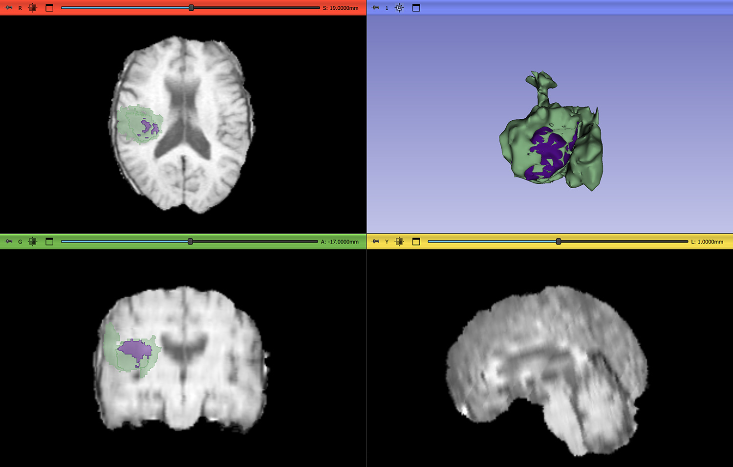 &lt;strong&gt;Figure 1.&lt;/strong&gt; Three-dimensional visualization of a brain tumor that includes both enhancing and non-enhancing regions of the brain. Figure courtesy of the author.