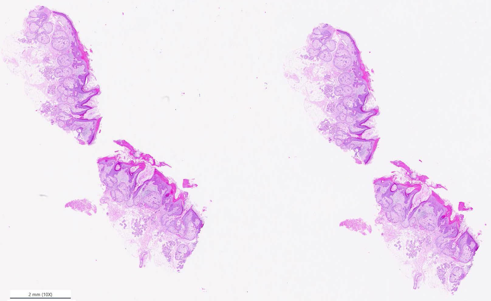 &lt;strong&gt;Figure 1.&lt;/strong&gt; A digitized glass slide that contains four tissue slices of the skin that are stained with hematoxylin and eosin. The scan is roughly 80,000 pixels by 50,000 pixels in size. Figure courtesy of Centroderm and aisencia.