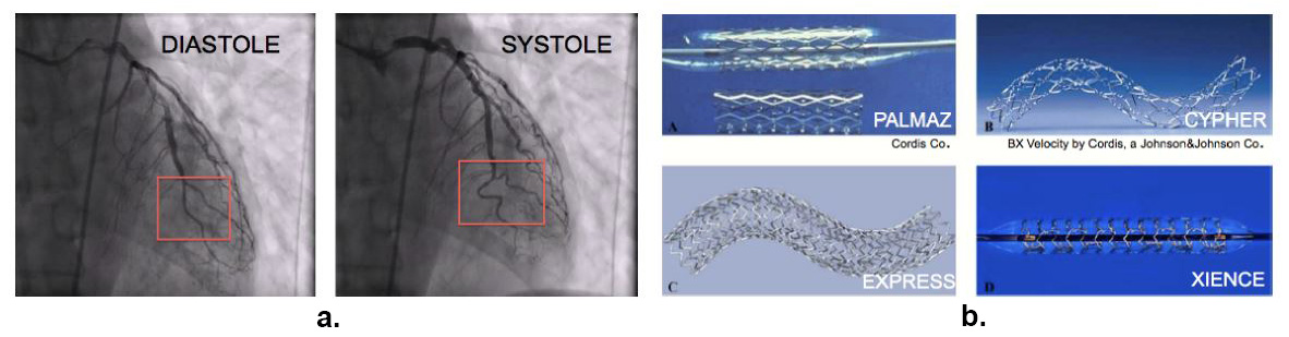 &lt;strong&gt;Figure 2. 2a.&lt;/strong&gt; A patient’s angiogram showing a curved coronary artery. &lt;strong&gt;2b.&lt;/strong&gt; Four different stents analyzed in [3]. 2a courtesy of David Paniagua, 2b courtesy of Boston Scientific and Abbott Vascular.