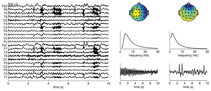 &lt;strong&gt;Figure 2.&lt;/strong&gt; At left, CPD of wavelet transformed EEG showing a 10-second onset of a right temporal lobe complex partial seizure. Muscle (at five and nine seconds) and eye blink artefacts (sharp wave) are visible. At right, the spatial (top), frequency (middle), and temporal modes (bottom) are shown. The epileptic atom is on the left, the eye blink artefact on the right. Adapted from [5].