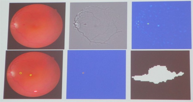 Screening methods detect the existence of hemorrhages—which indicate diabetic retinopathy—in fundus images.