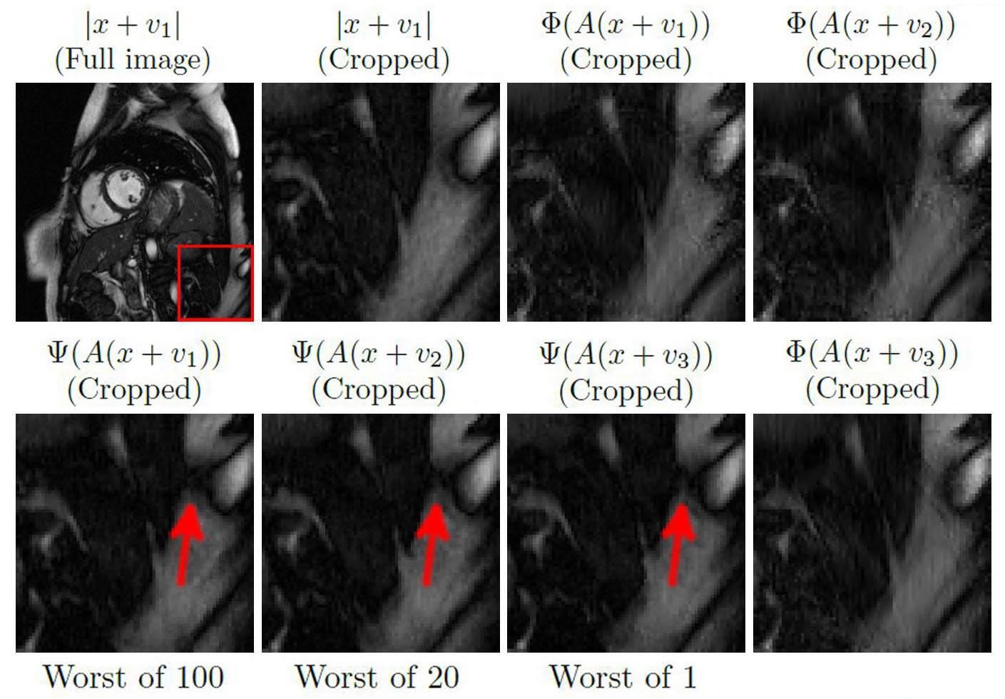 &lt;strong&gt;Figure 3.&lt;/strong&gt; The deep MRI network [8] is unstable with respect to Gaussian noise and produces false image regions. 100 Gaussian noise vectors \(w_j \in \mathbb{C}^{N}\) were computed, then the eyeball metric was used to pick the one (subsequently labeled \(v_1\)) for which \(\Psi(A(x+w_j))\) yields the largest artifact. This process was then repeated with 20 noise vectors, as well as one new noise vector, to give perturbations \(v_2\) and \(v_3\) respectively. The red arrows indicate that \(\Psi\) introduces a false dark area. Poor conditioning does not cause this instability since \(\mathrm{cond}(AA^*) = 1\) as before. Conversely, the sparse regularization method \(\Phi\) accurately recovers the image without the false region. Figure courtesy of [4].