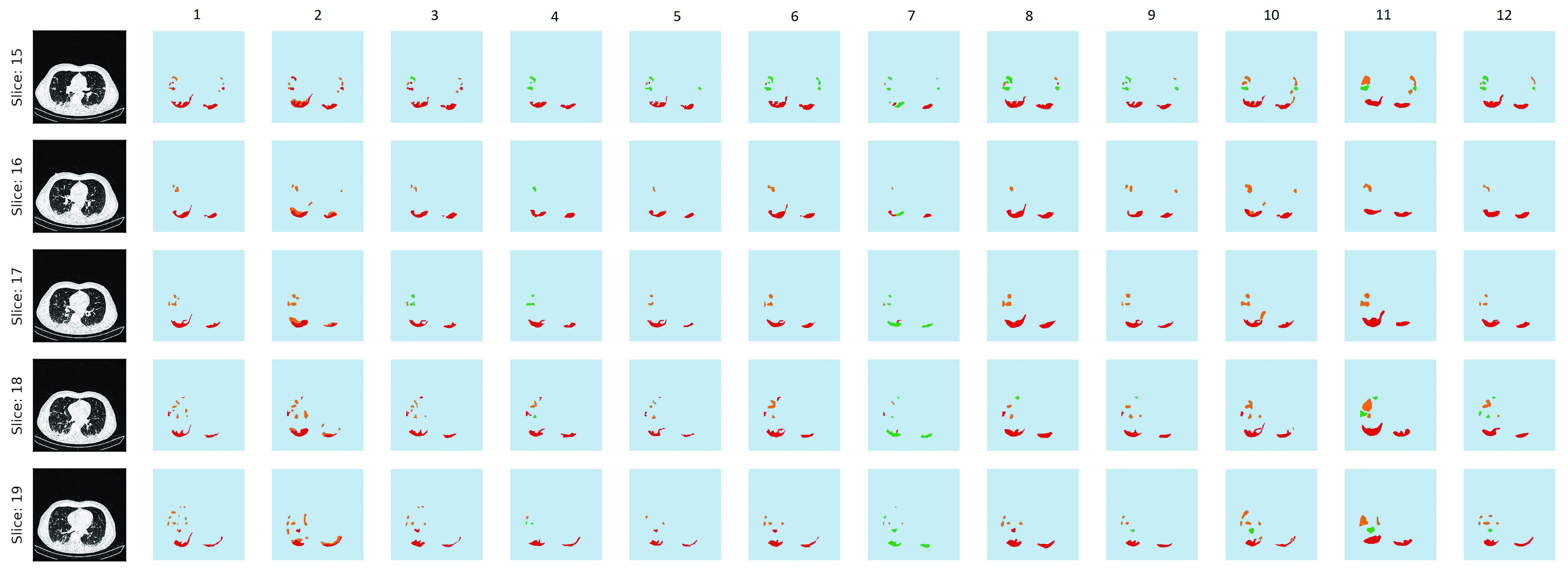 &lt;strong&gt;Figure 3.&lt;/strong&gt; Variability between 12 physicians who segmented the same image slices.