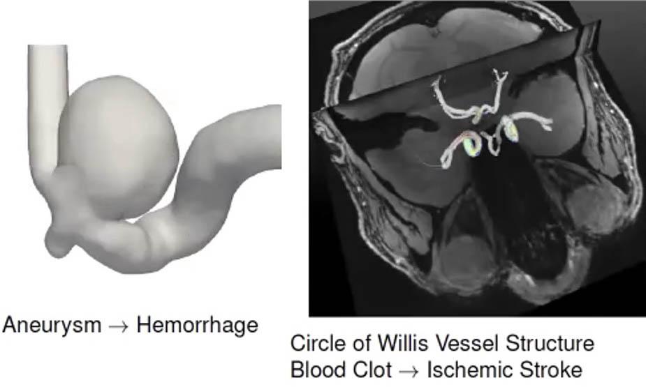 &lt;strong&gt;Figure 1.&lt;/strong&gt; Examples of cerebrovascular diseases that arise due to issues with blood vessels in the brain. Figure courtesy of Sahani Pathiraja.