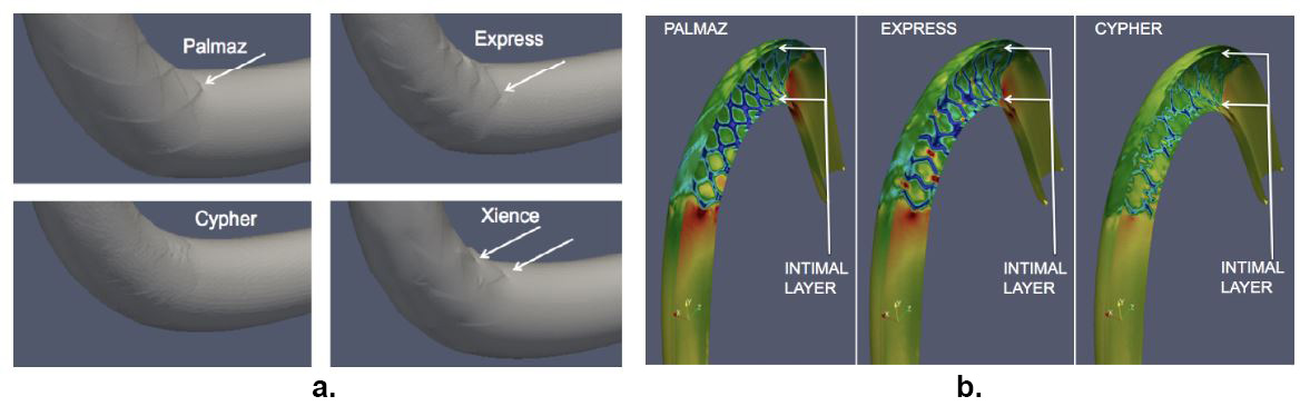 &lt;strong&gt;Figure 3. 3a.&lt;/strong&gt; The intimal layer with four different stents showing possible damage to the intima. &lt;strong&gt;3b.&lt;/strong&gt; Stress experienced by the intima; red designates excessive elastic deformation and blue represents resistance to deformation. The colors indicate deviation from normal stress values (green). Cypher-like stents have the best performance. Figure courtesy of Sunčica Čanić research group.