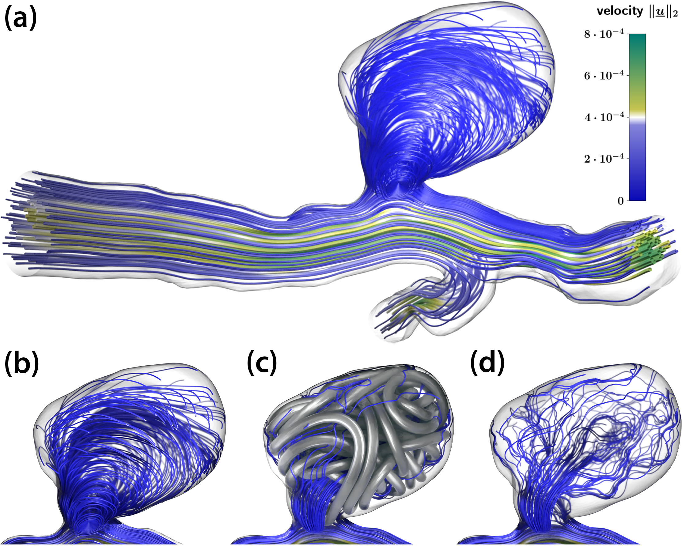 &lt;strong&gt;Figure 2.&lt;/strong&gt; Flow pattern within aneurysm geometries, visualized by streamlines. &lt;strong&gt;2a.&lt;/strong&gt; Full flow pattern within the vessel geometry. &lt;strong&gt;2b.&lt;/strong&gt; Zoomed in view of streamlines within uncoiled aneurysm geometry, with a visible vortex circulation pattern. &lt;strong&gt;2c&lt;/strong&gt;. Streamlines in the same aneurysm after virtual coiling with the coil present. &lt;strong&gt;2d.&lt;/strong&gt; Streamlines from 2c where the coil is invisible. The vortex pattern is broken and creeping flow is evident between the coiling wires. Figure courtesy of the authors.