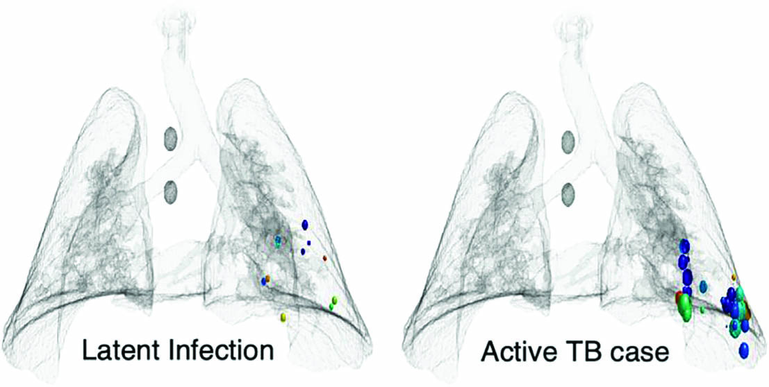 &lt;strong&gt;Figure 2.&lt;/strong&gt; Simulated lungs with tuberculosis (TB) granulomas that were created using an agent-based model. The lungs on the left have a latent asymptomatic infection, while the lungs on the right are experiencing full-blown TB symptoms because the granulomas have decayed and spilled their bacteria. Figure courtesy of [1].