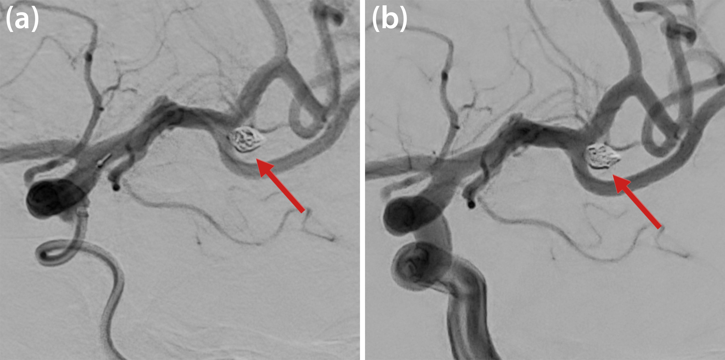 &lt;strong&gt;Figure 3.&lt;/strong&gt; Coiling of the non-ruptured aneurysm (red arrow) at the left middle cerebral artery bifurcation. &lt;strong&gt;3a.&lt;/strong&gt; The aneurysm is partially occluded after implantation of the first coil. &lt;strong&gt;3b.&lt;/strong&gt; Complete occlusion of the aneurysm after implantation of the second coil. Figure courtesy of the authors.