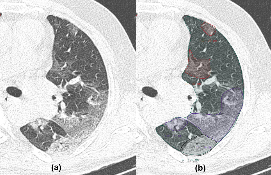 &lt;strong&gt;Figure 1.&lt;/strong&gt; Visualization of an axial slice of a computed tomography (CT) scan, cropped to the left lung. &lt;strong&gt;1a.&lt;/strong&gt; Pulmonary opacification present in a patient with COVID-19. &lt;strong&gt;1b.&lt;/strong&gt; The corresponding annotation generated by a radiologist. Red indicates pure ground-glass opacity (GGO), purple designates GGO with intralobular lines (crazy paving), and black signifies consolidation.