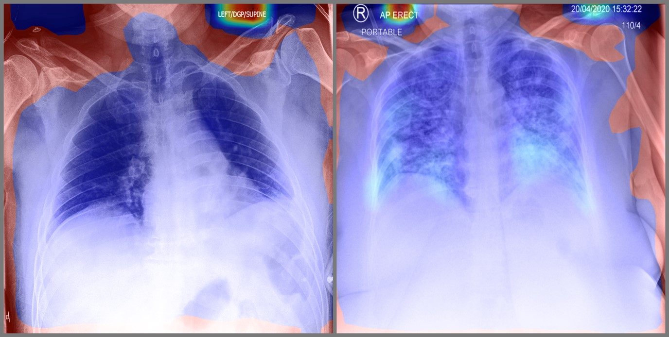 &lt;strong&gt;Figure 3.&lt;/strong&gt; Activation map depicting regions of interest for a neural network that detects lung abnormalities. Red areas indicate discriminative regions that the model uses to make its predictions. Original scans courtesy of the National Collaborating Centre for Infectious Diseases dataset [8].