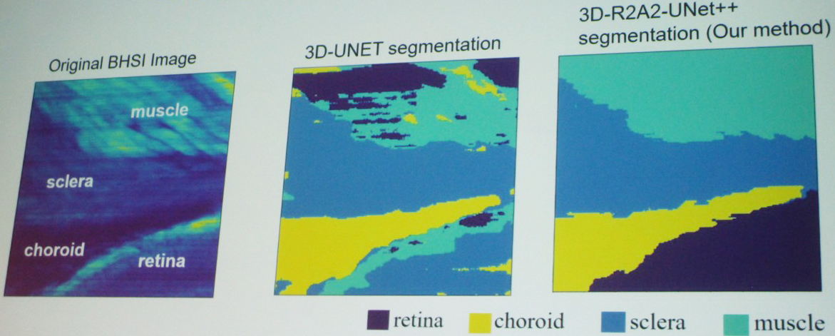&lt;strong&gt;Figure 2.&lt;/strong&gt; Visual comparison of segmentation results between an original biomedical hyperspectral fluorescence image, three-dimensional (3D)-UNET segmentation, and Na Yu’s 3D-R2A2UNet++ segmentation. Figure courtesy of Na Yu.