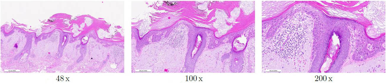 &lt;strong&gt;Figure 2.&lt;/strong&gt; Three image patches with the same resolution that were extracted at different magnification levels. Figure courtesy of Centroderm and aisencia.