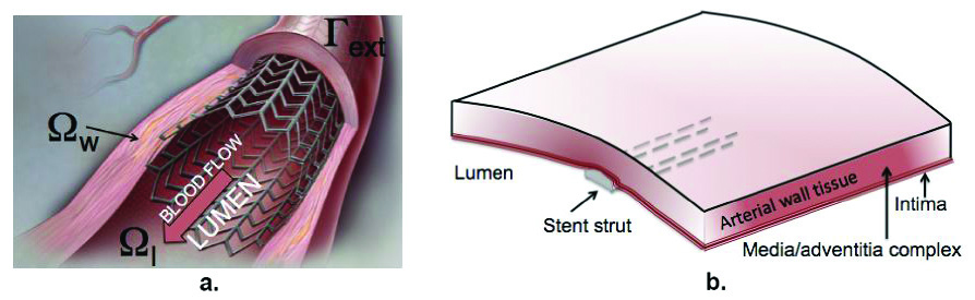 &lt;strong&gt;Figure 1.&lt;/strong&gt; Stents restore normal blood flow in diseased arteries. &lt;strong&gt;1a.&lt;/strong&gt; A sketch of an implanted stent. &lt;strong&gt;1b.&lt;/strong&gt; A magnified view of a section of the multilayered arterial wall containing a stent strut. 1a is a public domain image, 1b courtesy of Sunčica Čanić.